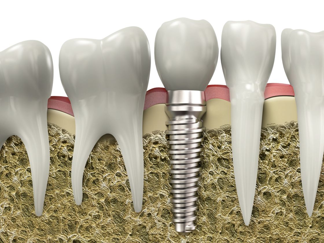 varastegan-dental-implant